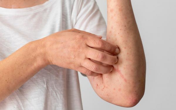 Lupus Hanya Dialami oleh Perempuan, Mitos atau Fakta